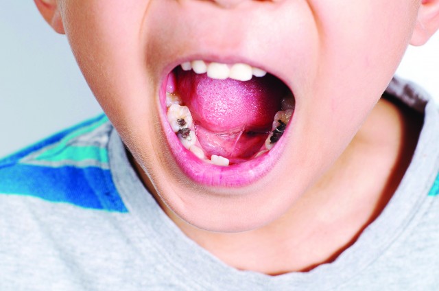 تسوس الاسنان عند الأطفال